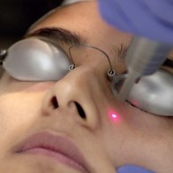 Laser Treatments