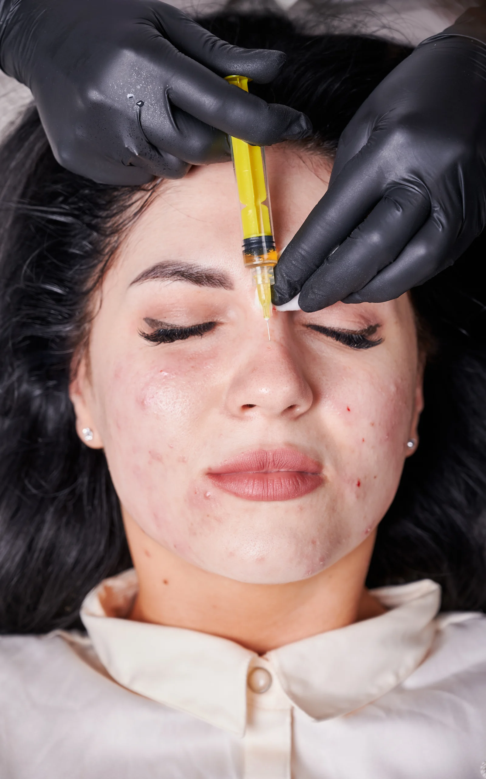 Scar Treatment for Smoother, Clearer & Even Skin
