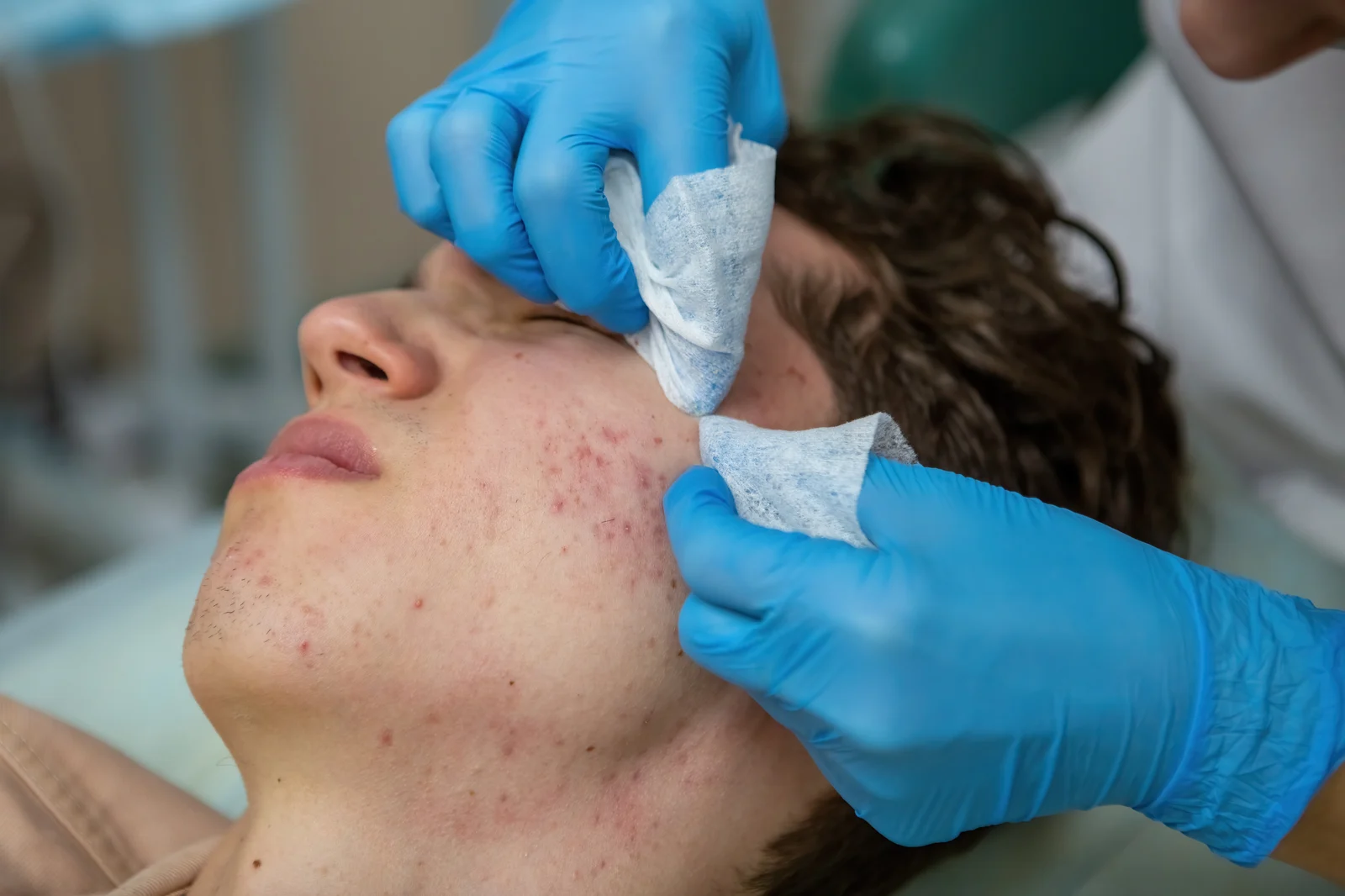 How Scar Treatment with Fillers and Threads Works
