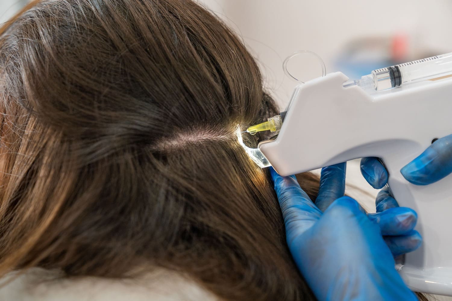 Advanced Mesotherapy for Hair Regrowth & Thickness