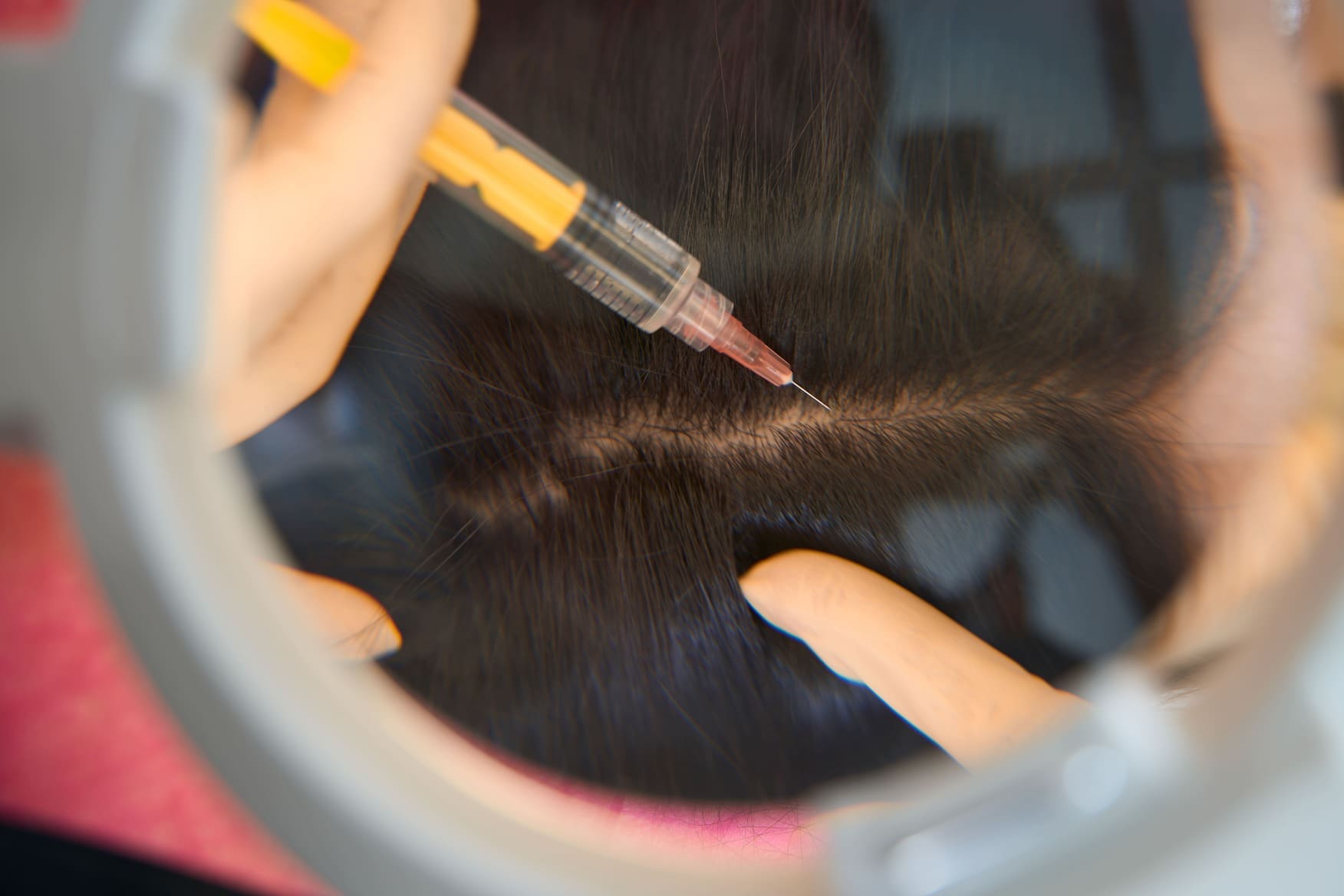 How PRP Hair Rejuvenation Works