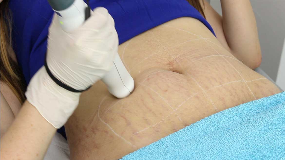 Stretch Marks Reduction for Smoother, Even & Refined Skin